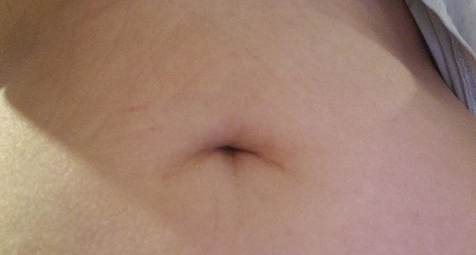 A través de las incisiones, el personal médico tiene acceso al campo quirúrgico y puede realizar el procedimiento.