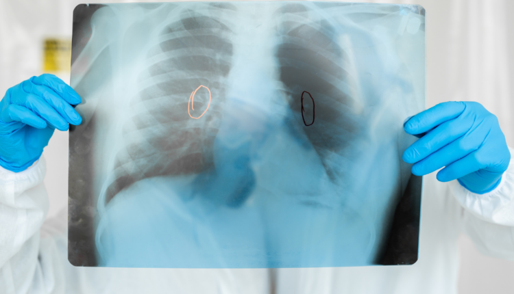 Cómo detectar y curar la tuberculosis a tiempo